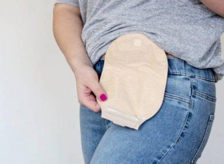 what to do when ostomy bag keeps leaking|20 Failproof Tips To Prevent Your Stoma From Leaking